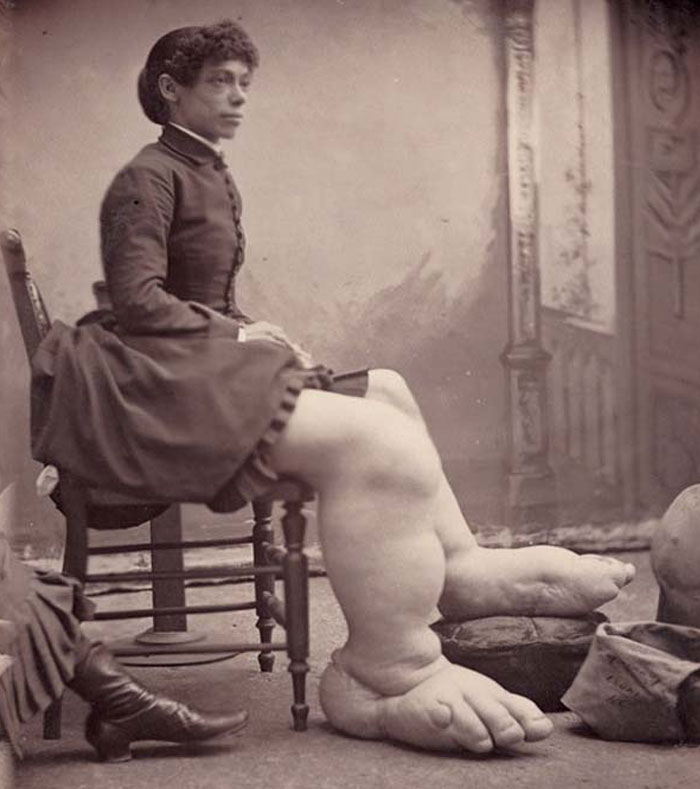 Vintage photo of a woman with unnaturally large, swollen legs sitting on a chair, creepy and unsettling history.