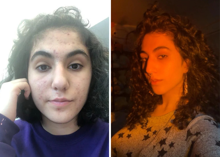 Before and after photos showing inspiring ugly ducklings glow-up transformation with clearer skin and styled hair.