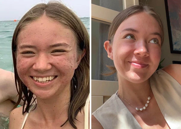 Side-by-side photos showing inspiring ugly ducklings glow-ups with clear skin and confident smiles in natural light.
