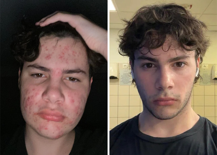 Before and after photos showing an inspiring glow-up of a young man once seen as an ugly duckling.