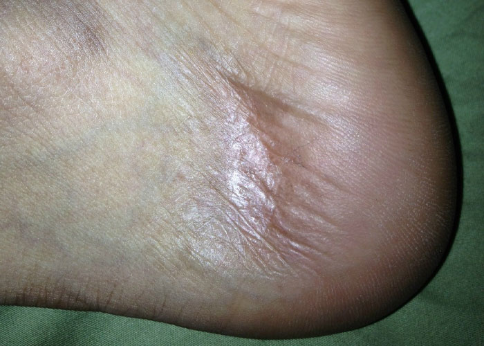 Close-up of a human heel with dry and c*****d skin showing an unbelievable experience people can prove.