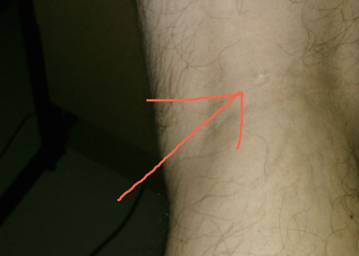 Close-up of a leg with an arrow drawn in red, highlighting an unusual mark as part of unbelievable experiences people share.