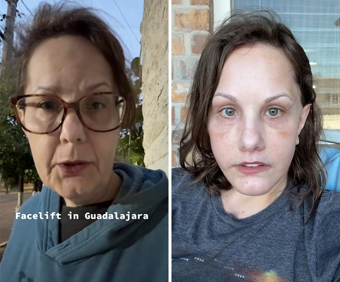 Before and after photos showing a woman's facelift transformation trending online after people see her look before surgery.