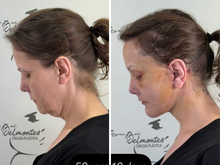 Side-by-side photos showing a woman's facelift transformation highlighting changes before and after surgery.