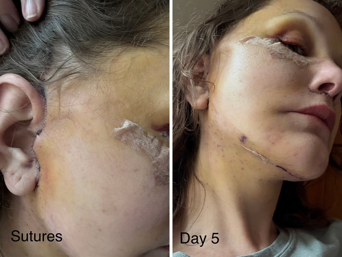 Close-up images of a woman&rsquo;s facelift recovery showing sutures and healing progress on day 5 post-surgery.