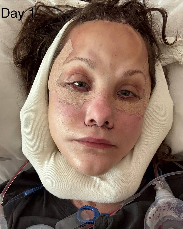 Woman's facelift recovery on day one showing swelling and surgical tape after cosmetic procedure.