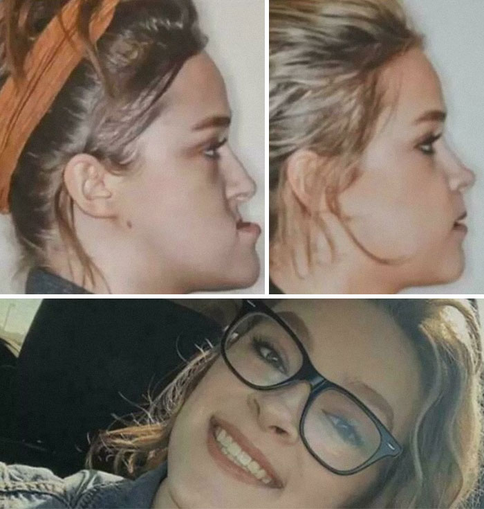 Side-by-side profile photos before and after medical case surgery, showing transformation in facial structure and smiling patient.