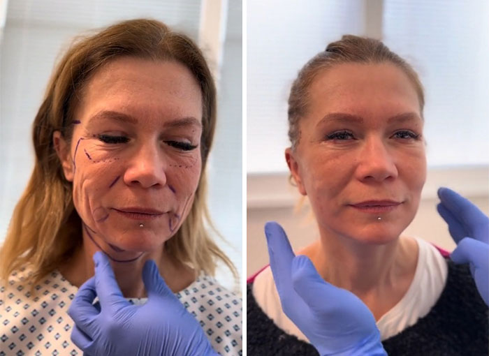 Before-and-after photos of a woman showing facelift results with marked skin and smoother, rejuvenated appearance.