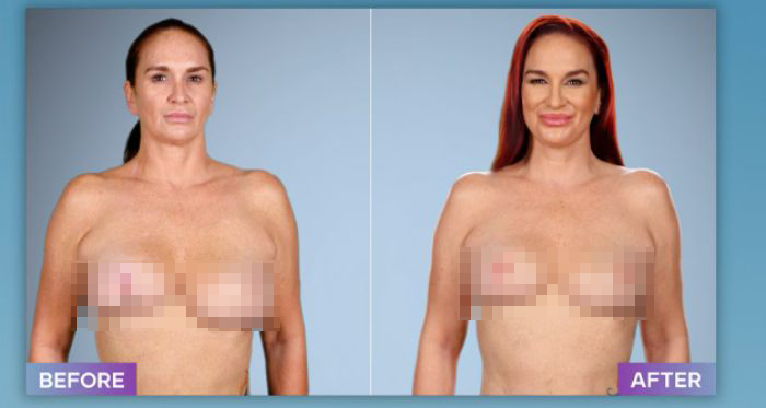 Before and after photos showing results of a plastic surgeon who fixes botched operations on a woman with red hair.