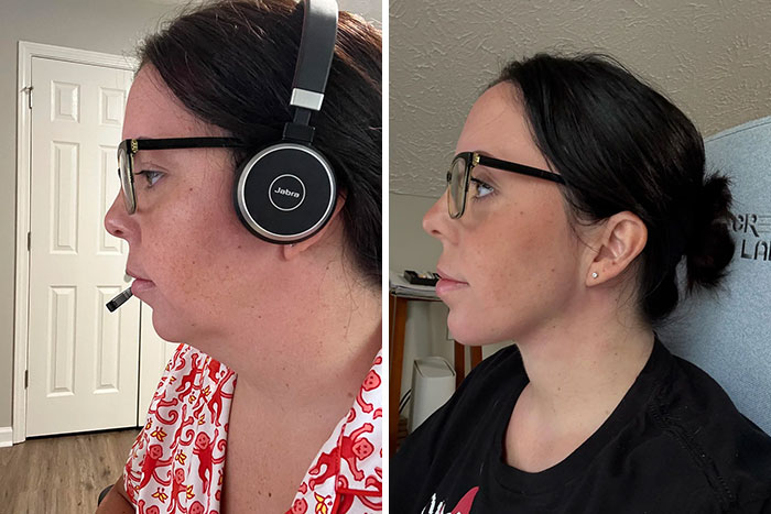Side-by-side before and after plastic surgery photos showing a woman’s transformed profile and jawline.