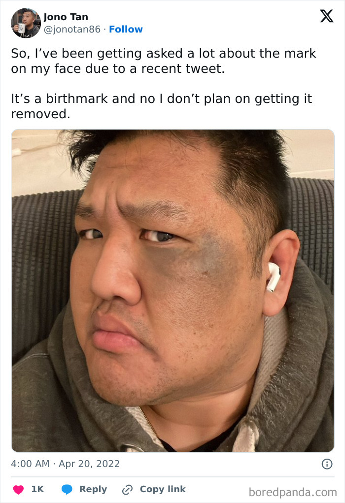 Man showing a large, unique birthmark on his face, wearing a gray hoodie and white wireless earbud.