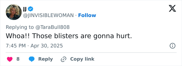 Tweet by user JJ mentioning painful blisters, relating to doctors warning about trendy freeze branding tattoo alternative risks. Tweet by user JJ mentioning painful blisters, relating to doctors warning about trendy freeze branding tattoo alternative risks.