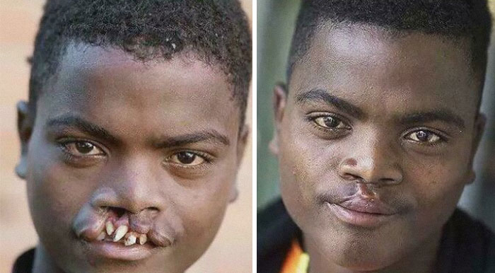 Before and after images of a medical case showing facial reconstruction surgery for a severe cleft lip deformity.