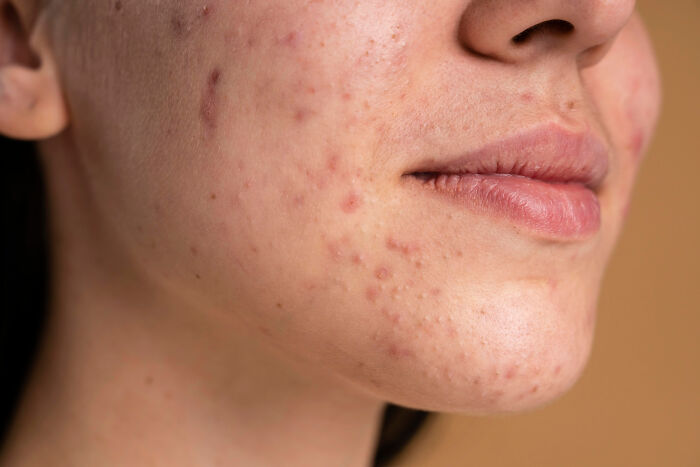 Close-up of a person's face with acne and blemishes, illustrating wild to disgusting things people really did in public.