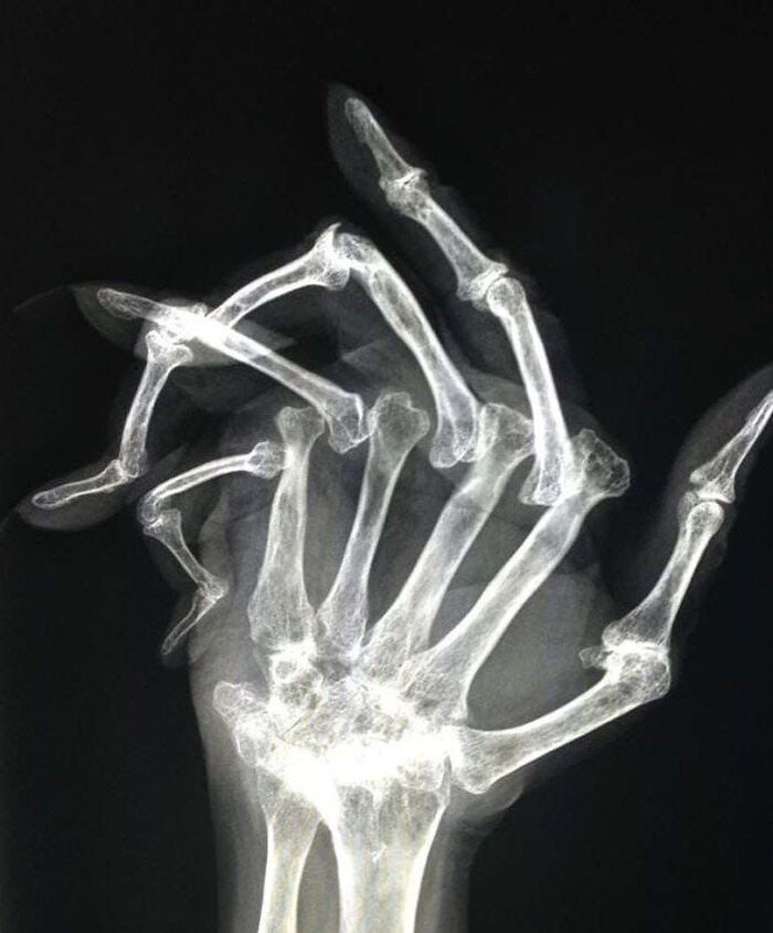X-ray image showing severely deformed hand bones, a striking example of medical photos revealing unusual conditions.
