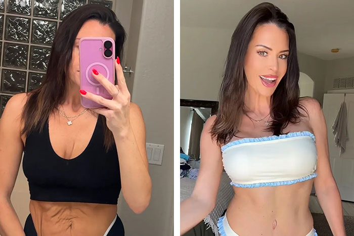 Before and after photos of a woman with 3 kids showing stunning mommy makeover transformation results.