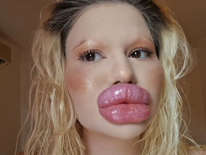 Woman with world&rsquo;s biggest lips shown close-up, highlighting extreme lip enhancement and cosmetic surgery results.