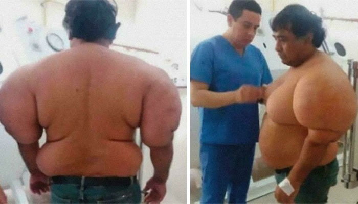 Man with large abnormal swelling on his torso examined by a medical professional in a clinical setting, illustrating rare medical cases.