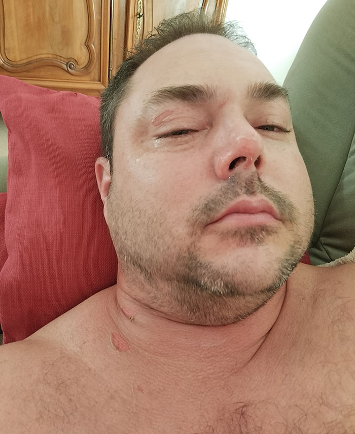 Man lying down with visible burn injuries on face and neck after domestic violence incident against ex-girlfriend.