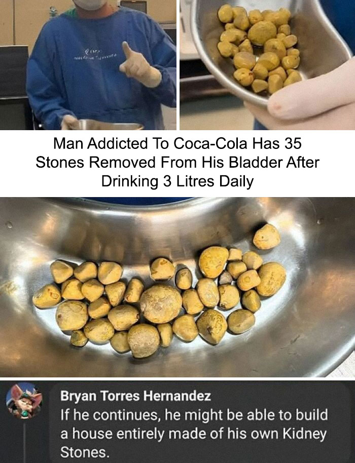 Doctor showing bladder stones removed from a man a******d to Coca-Cola, part of funny science memes collection.