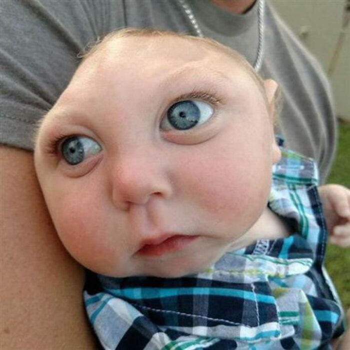 Distorted baby face showing unusual eye placement, a medical photo that is both fascinating and deeply disturbing.