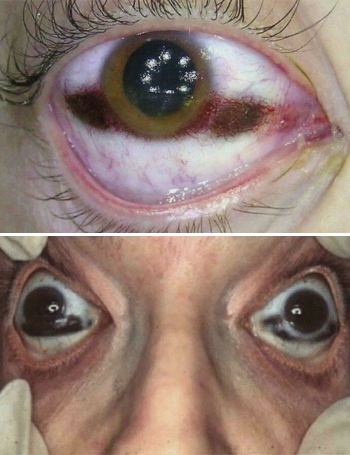 Close-up images of unusual and gory medical eye conditions showing severe redness and eye abnormalities.