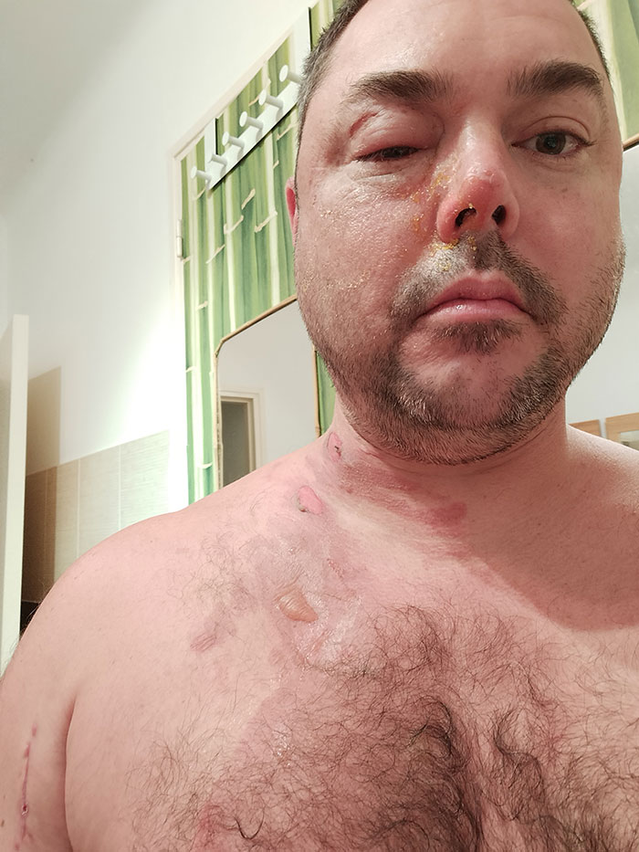 Man showing severe facial and chest burns after domestic violence incident in a landmark case against ex-girlfriend.