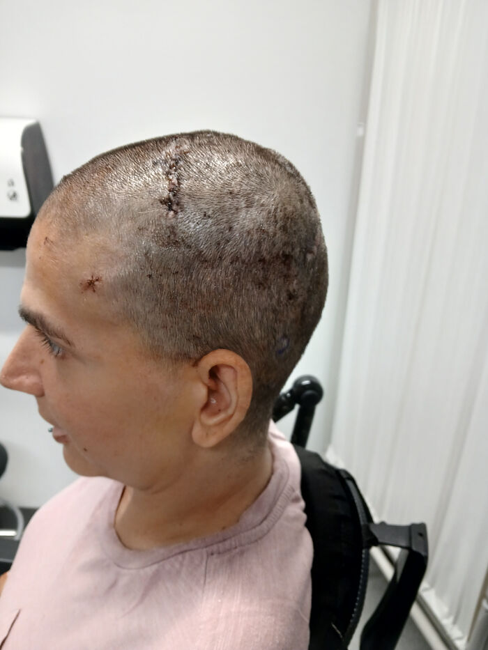 Paralyzed woman with shaved head and healing scars after Neuralink brain chip implant in a medical setting. - 6