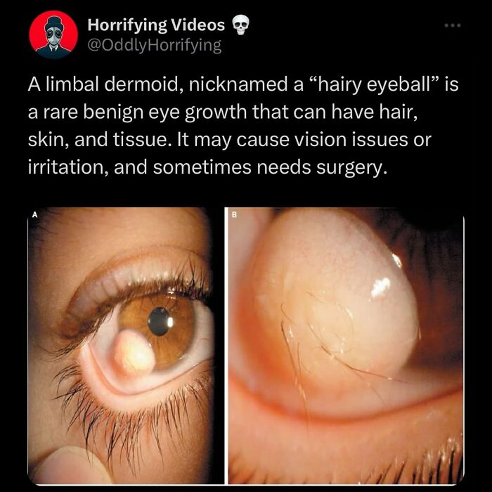 Close-up images of a limbal dermoid, a rare benign eye growth with hair, showing an odd and horrifying medical condition.
