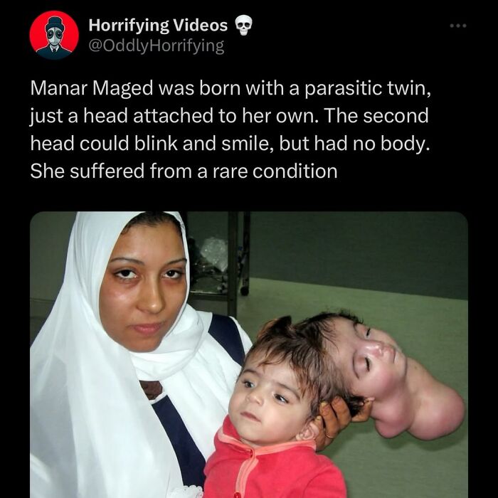 Woman holding a child born with a parasitic twin, showing one head attached without a body, an unnerving image.