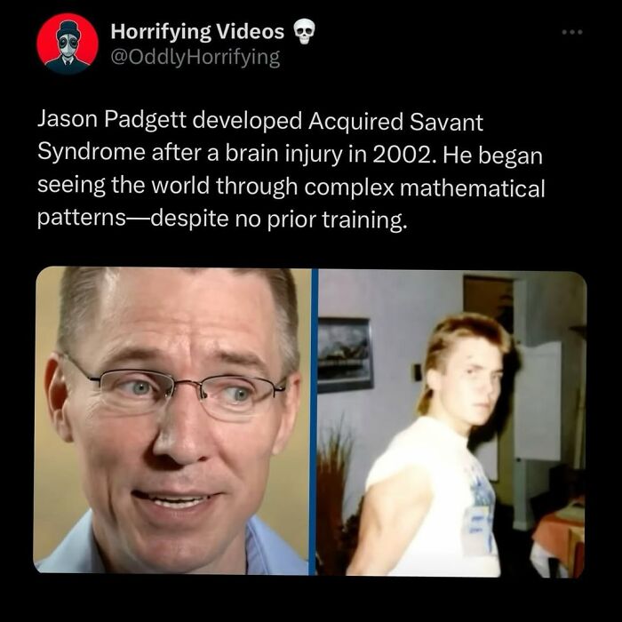 Two side-by-side photos of a man showing changes before and after a brain injury linked to oddly horrifying acquired savant syndrome.