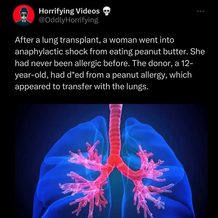 Twitter post from Horrifying Videos describing a lung transplant causing anaphylactic shock due to peanut allergy transfer.