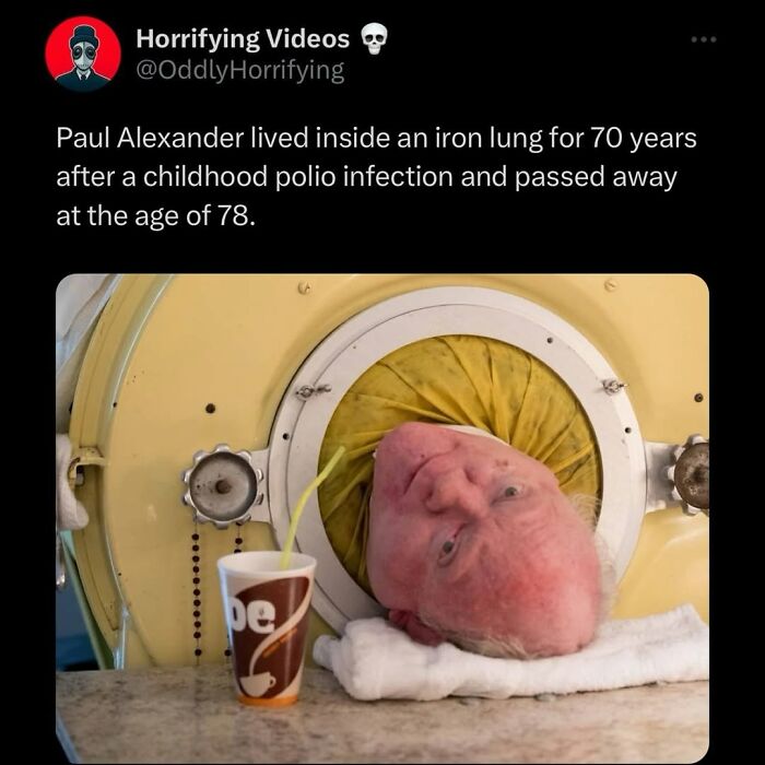 Paul Alexander’s head inside an iron lung machine with a cup, a disturbing and unnerving medical image.