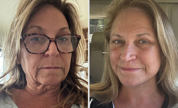 Before and after photos of a woman showing noticeable facial improvements from a facelift procedure.