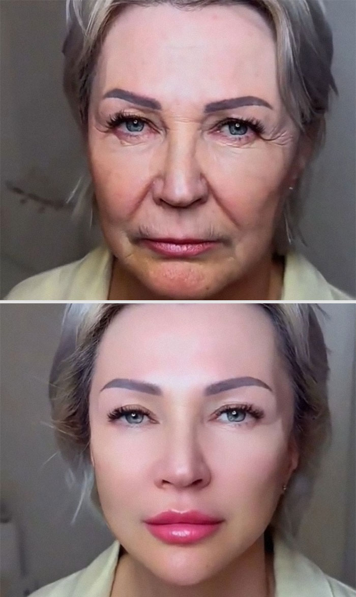 Before and after facelift photos showing a woman’s smoother skin, lifted features, and youthful facial transformation.