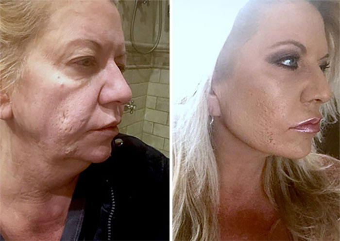 Before-and-after facelift photos showing significant facial rejuvenation and improved skin texture on a middle-aged woman.