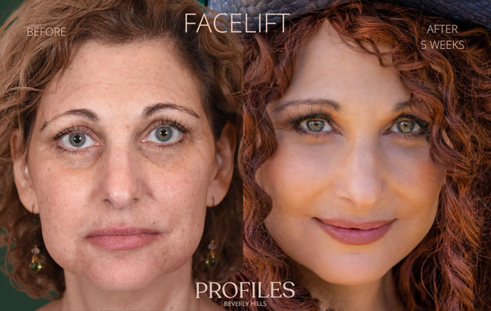 Before-and-after facelift photos showing a woman’s facial transformation five weeks after the procedure.