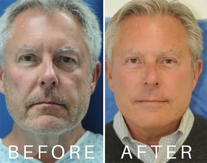Before and after facelift photos of a middle-aged man showing noticeable facial rejuvenation and smoother skin.