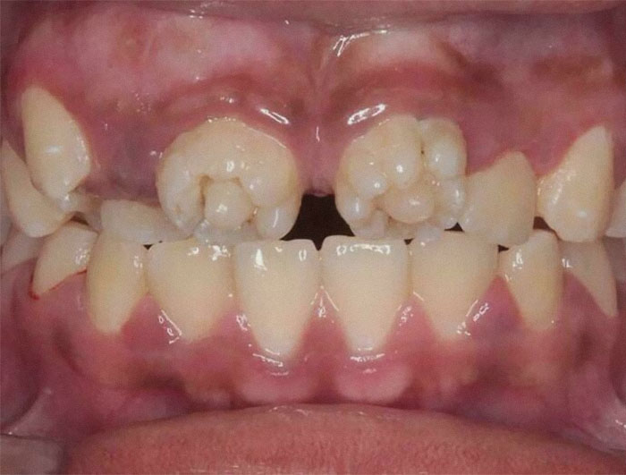 Close-up of a rare medical case showing severely malformed and gory teeth with unusual dental abnormalities.