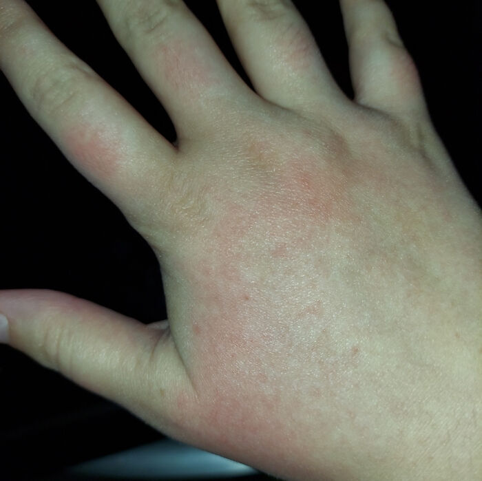 Close-up of a hand showing mild redness and irritation, illustrating unexpected work fails affecting health.