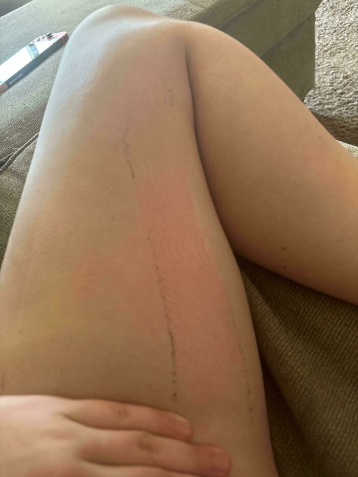 Leg showing red marks and ink lines from forgetting something, illustrating funny unfortunate situations involving people.