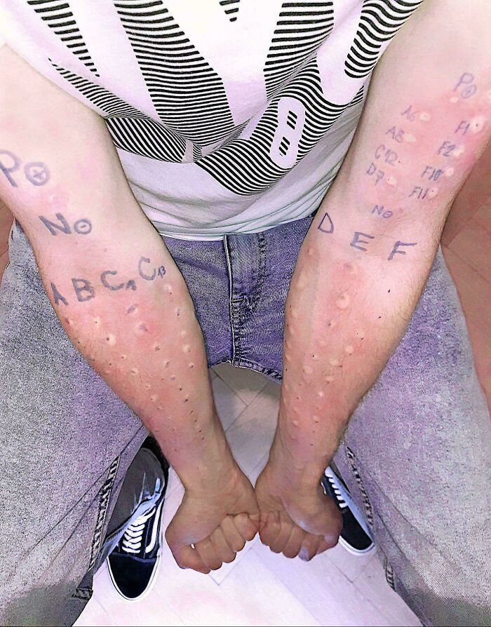 Person showing arms with written labels and marks from mild allergy testing, a mildly interesting sight to see.