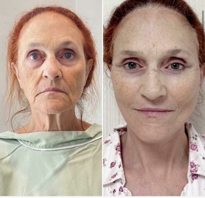 Before-and-after photos showing facelift results on a middle-aged woman with red hair and blue eyes.
