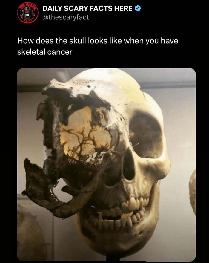 Skull severely damaged by skeletal cancer, showing scary facts about bone deterioration in a dark setting.