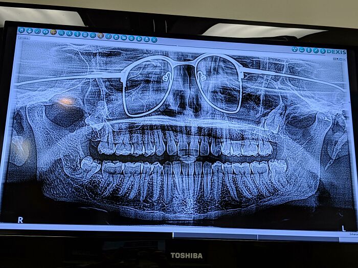 X-ray image showing a skull with glasses left inside the mouth, illustrating funny unfortunate situations.
