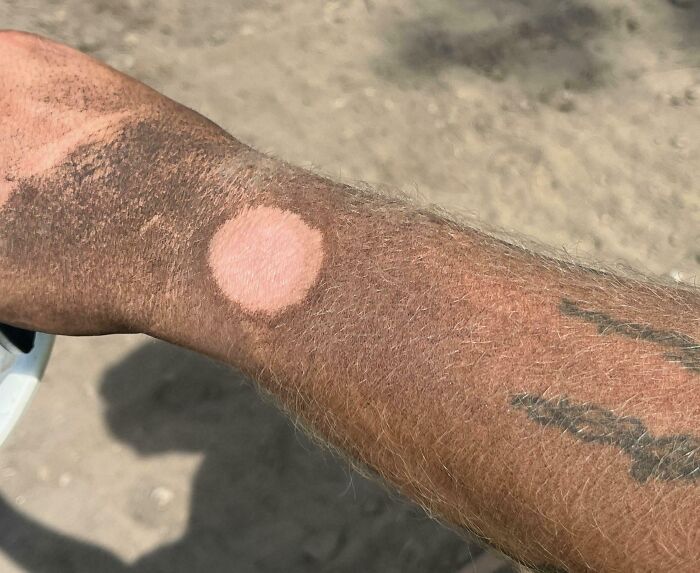 Sunburned arm with a circular patch of untanned skin showing a funny unfortunate situation of forgetting sunscreen.