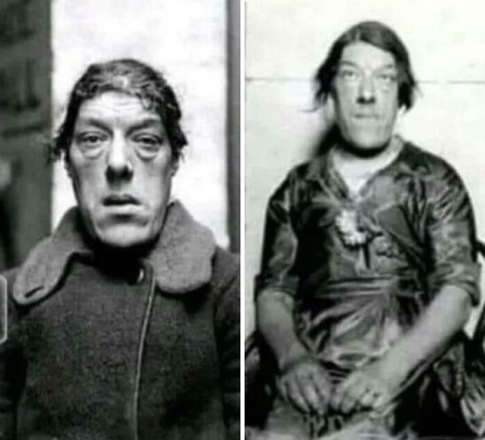 Black and white photos of a man with unusual facial features, showcasing unusual and cool world facts.