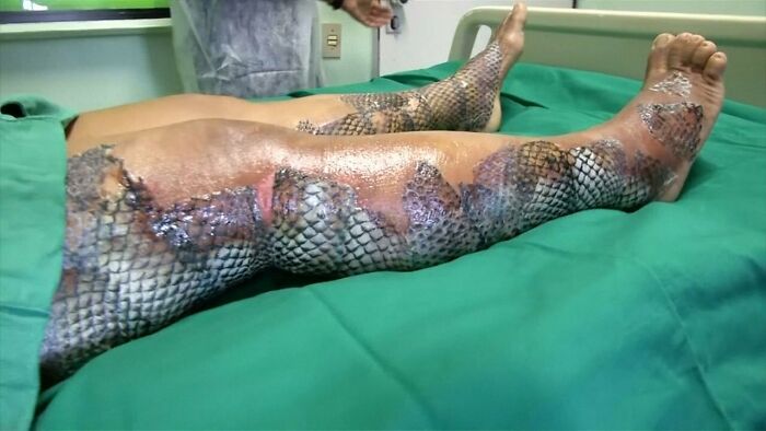 Severe medical burn injuries on legs with skin grafts resembling scales in a clinical hospital setting on a green sheet.