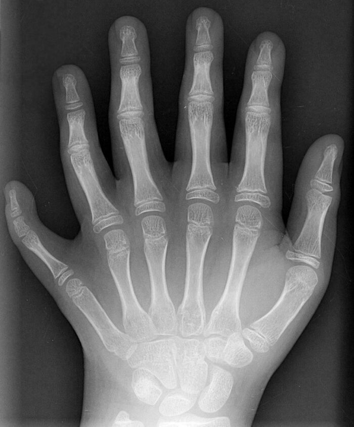 X-ray of a hand showing an unusual bone structure, part of a collection of fascinating medical photos.