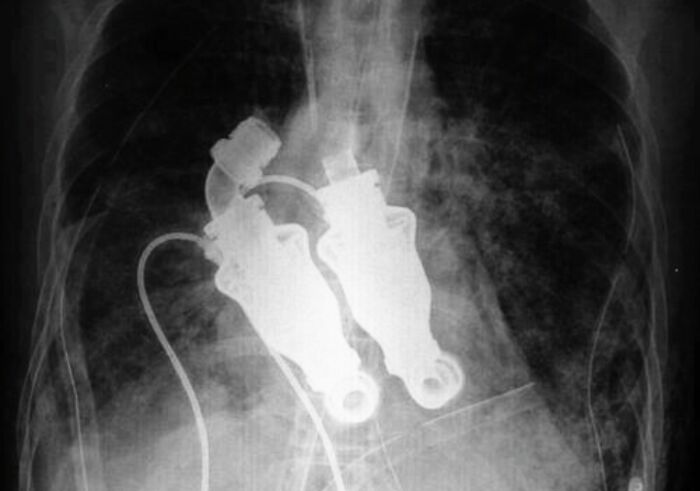 X-ray image showing a medical device implanted in the chest, illustrating fascinating and deeply disturbing medical photos.